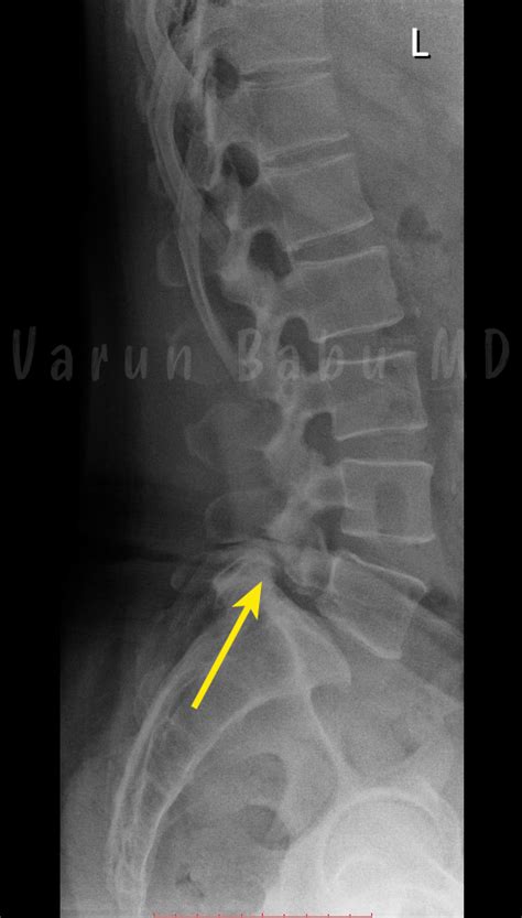 Pars Interarticularis Defect Elearn Radiology