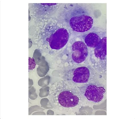 Histiocyte Proliferation In The Bone Marrow Of Patient In Remission
