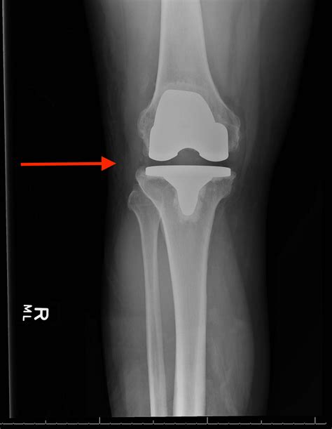 Cureus Bilateral Patellar Tendon Rupture Following Total Knee