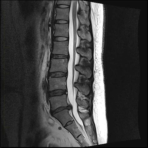 Understanding Mri Lower Lumbar Spine