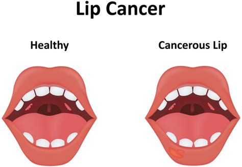 Causes Of The White Bumps On Lips Std Gov Blog