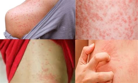 7 Things You Should Know About Amoxicillin Rash Pictures Meds Safety