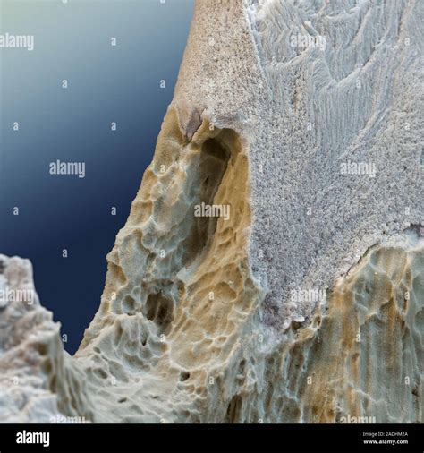 Osteoporotic Bone Coloured Scanning Electron Micrograph Sem