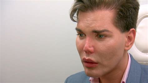 Botched Patient Rodrigo Alves Learns His Nose Could Die And Fall Off After Extreme Plastic