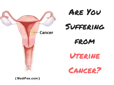 Endometrial Cancer Types Symptoms Diagnosis And Prevention