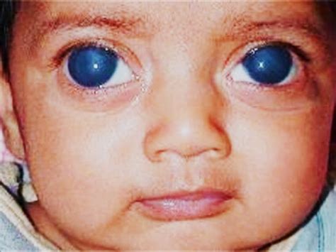 Listado de enfermedades de la a a la z. Glucoma: Qué es y cómo prevenirlo: Tipos de Glaucoma ...