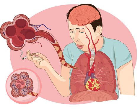 Definición de Enfermedades Respiratorias