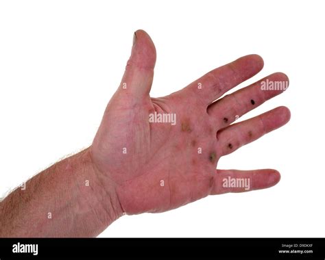 A Mans Left Hand With Blisters And Red Chaffing On A White Background
