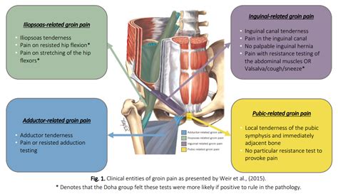 The preperitoneal anatomy seen in laparoscopic hernia repair led to the characterization of important anatomic areas of interest, known as the. What happened to Osteitis Pubis? Classifying groin pain for better rehab outcomes.