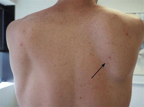 Scapular Shoulder Blade Problems And Disorders Orthoinfo Aaos 2023