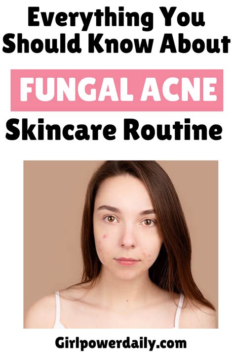 Fungal Acne Causes And Treatment Girl Power Daily Guide To Skincare