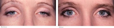 Procedures Droopy Upper Eyelids Ptosis Michael J Groth Md