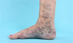 Varicose veins - expert explains if heart conditions cause condition - Health - Life & Style ...  Heart and Circulation Varicose Veins