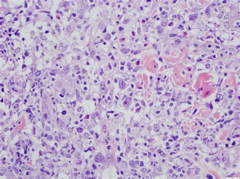Pathology Outlines Lymphomatoid Papulosis