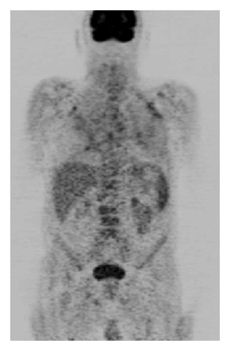 An 82 Year Old Man With Gastric Malt Lymphoma A Mip Image Of