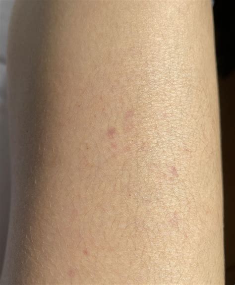 What Are These Purplishreddish Spots On My Thigh Rskin
