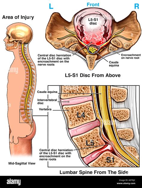 Massive L S Lumbar Disc Herniation With Nerve Root Impingement My Xxx