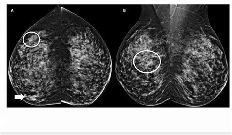 In The Initial Digital Mammography Cc A And Mlo B Projections Show