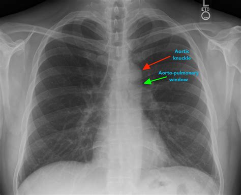 Αποτέλεσμα εικόνας για Aortic Arch Chest X Ray Interpretation X Ray