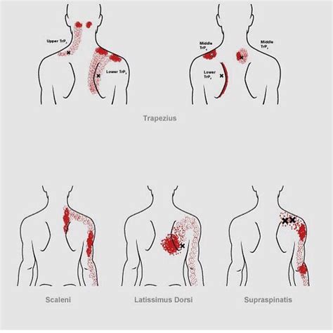 Got Trigger Points No Problem We Can Help With That Serenetouchmassage Acupressure
