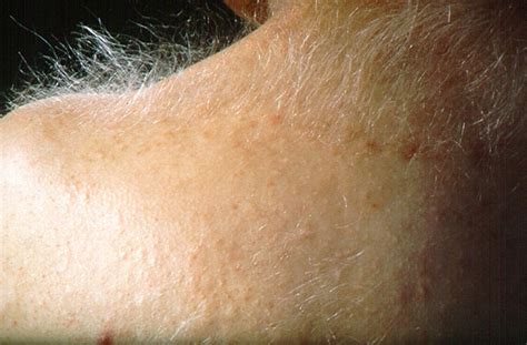 The Group Of Epidermal Nevus Syndromes Journal Of The American