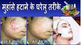 Images of Acne Marks Treatment At Home