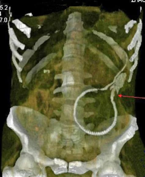 Porn Addict Has Emergency Surgery To Remove Live Eel He Inserted Up His Backside To Copy X Rated