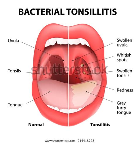 Tonsillitis Bacterial Angina Pharyngitis Tonsillitis Infection Stock