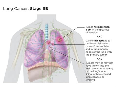 Lung Cancer Staging Lungevity Foundation