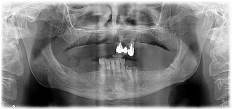 Bar Retained Implant Overdenture For Treating Edentulous Maxilla Trate