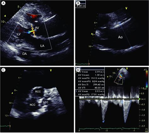 Aortic Valve Sclerosis In 100 Year Old Woman With Hypertension A B