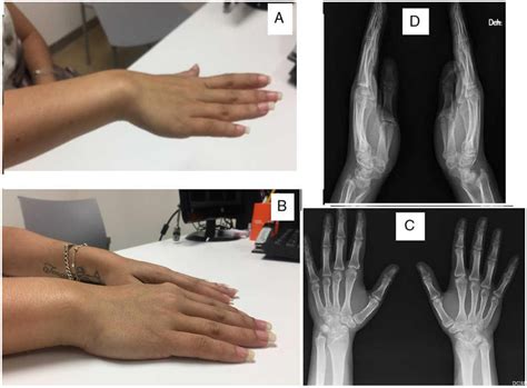 Madelung Deformity Article