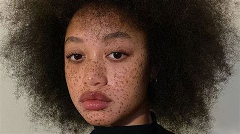 8 Things You Never Knew About Freckles
