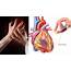 Myocardial Infarction Heart Attack  Top Neuro Docs