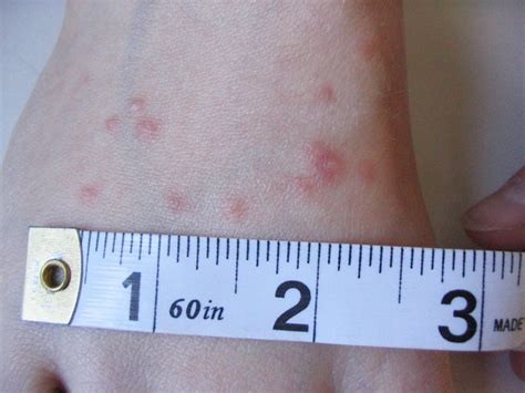 Chigger Bites What They Look Like Prevention Treatment The Healthy