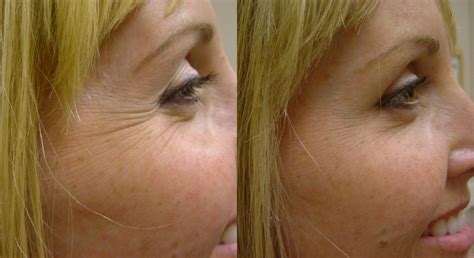 Botox Treatment For Crows Feet Before And After Photo