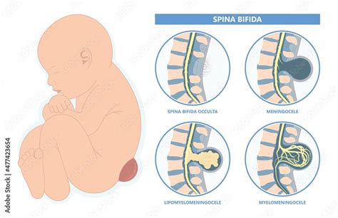 Spina Bifida Pregnancy Non Invasive Neural Tube Gene Afp Ntd Infant
