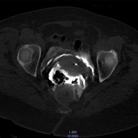 Axial Ct Image Of The Pelvis Shows The Presence Of Barium Contrast