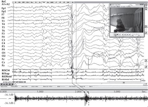 Jle Epileptic Disorders Ictal Vocalizations Are Relatively Common