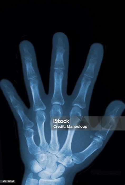 Xray Dari Tangan Dan Tulang Kontur Manusia Foto Stok Unduh Gambar Sekarang Ahli Radiologi
