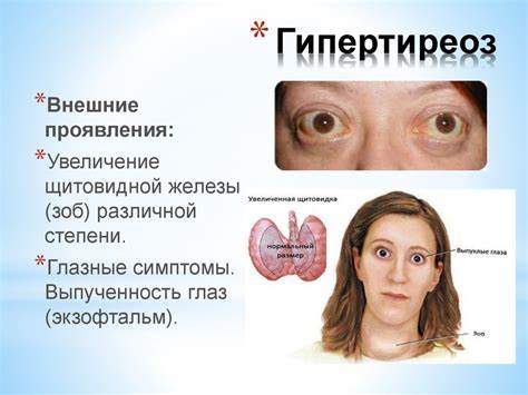 Диета и гипертиреоз Эндокринная система - презентация онлайн Эндокринная система - презентация онлайн Диета и гипертиреоз