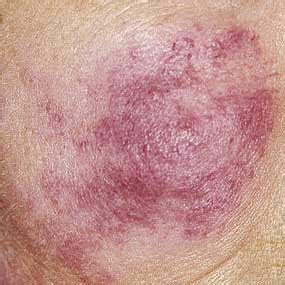 Lupus (or sle) is a complex disease. A Closer Look at Lupus: (Pictures)