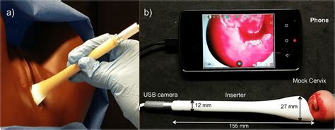 A Vaginal Inserter With Digital Colposcope Inserted Imaging A