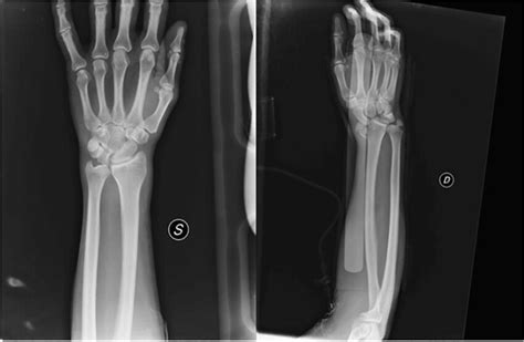 Left And Right Wrist Preoperative Anteroposterior X Rays Download