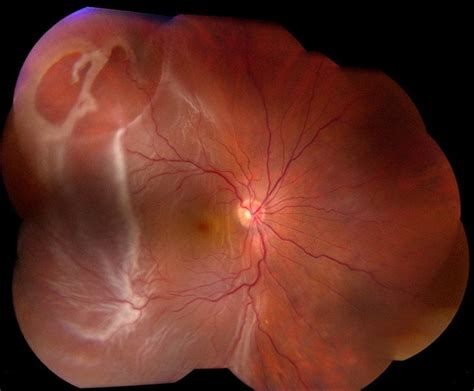 Giant Retinal Tear With Rd Retina Image Bank