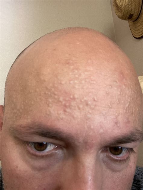 Forehead Bumps Adult Acne Forum