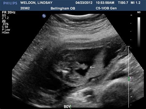 Mr And Mrs Weldon 20 Weeks Pregnant Means20 Week Ultrasound