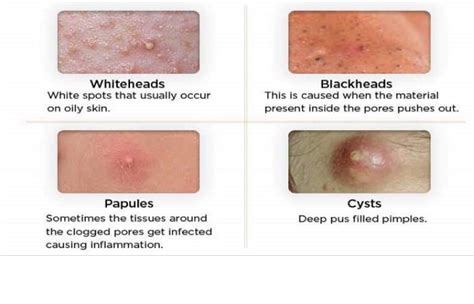 Types Of Acne The Best Treatment For The Different Types Of Acne