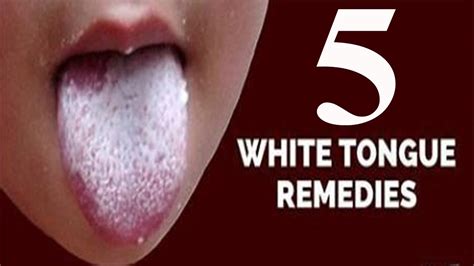 5 Home Remedies For A White Coated Tongue Youtube