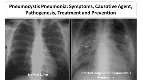 Pneumocystis Pneumonia Symptoms Causative Agent Pathogenesis